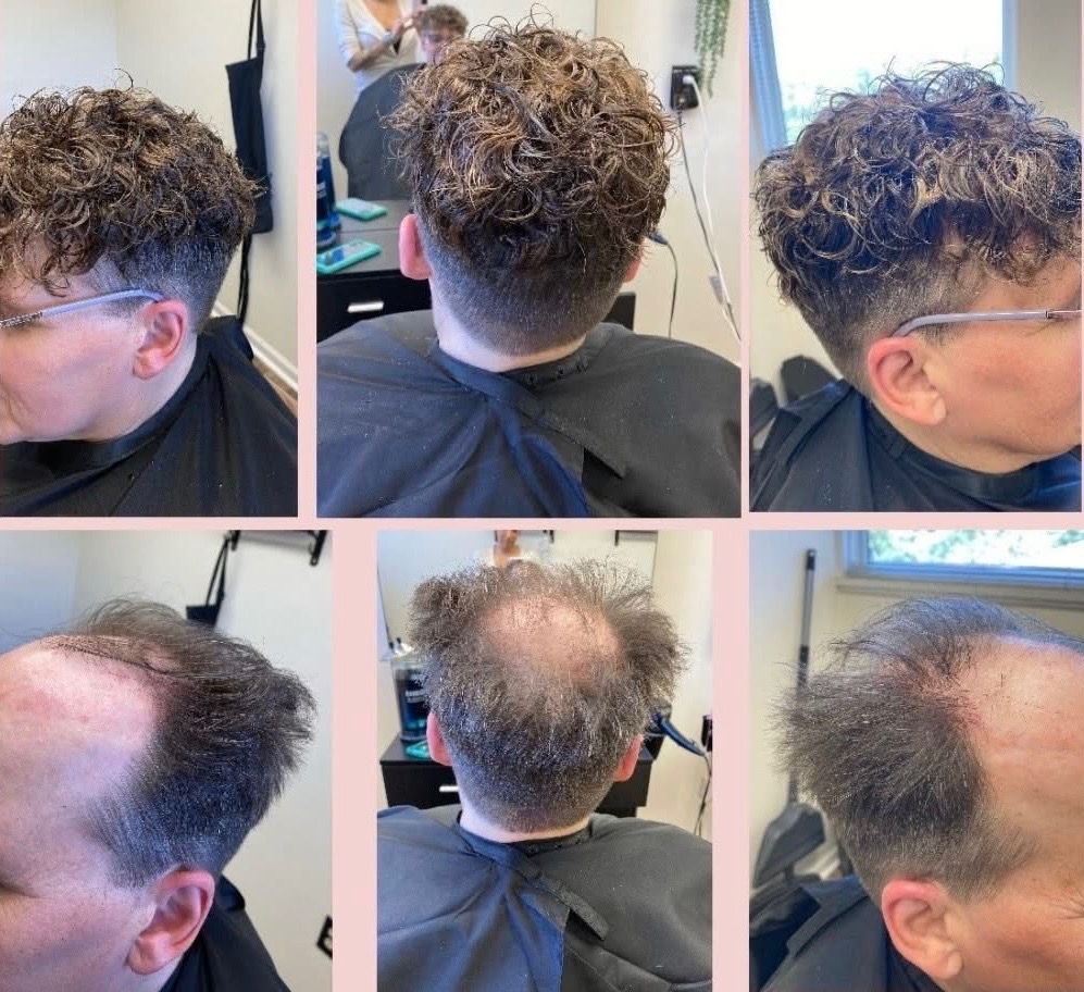 Hair Restoration